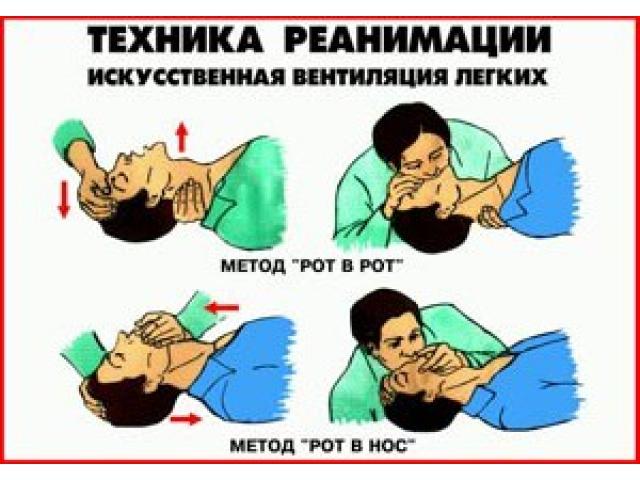 ГОРИЗОНТ Искусственная вентиляция легких методы рот в рот рот в нос