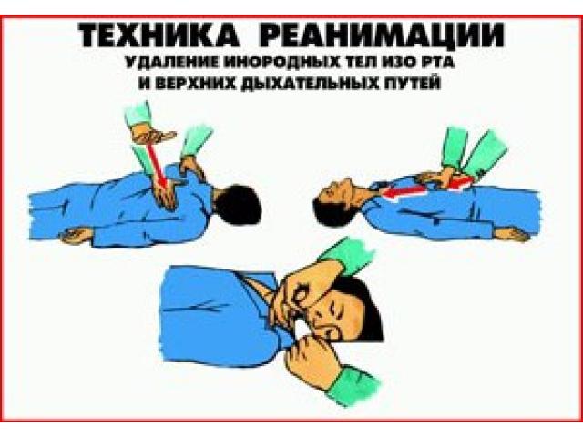 ГОРИЗОНТ Удаление инородных тел изо рта и верхних дыхательных