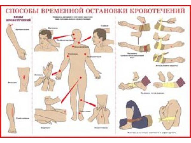 Способы временной остановки кровотечения