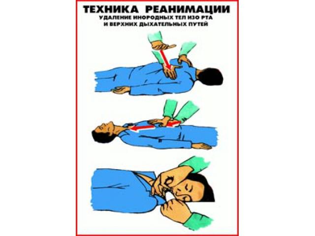 Удаление инородных тел изо рта и верхних дыхательных