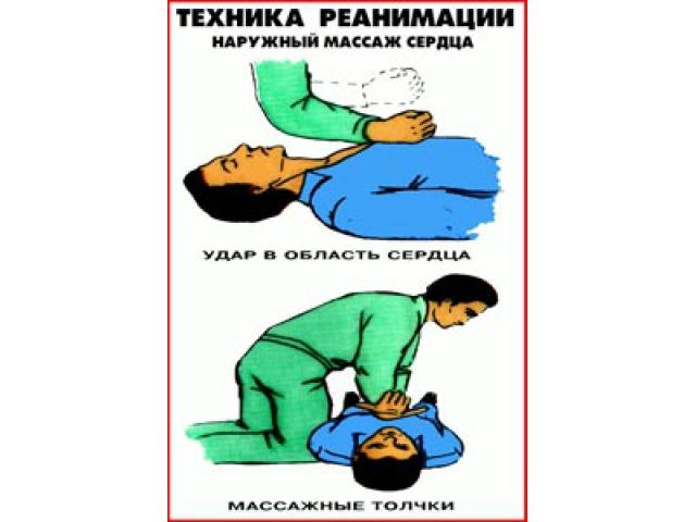 Наружный массаж сердца