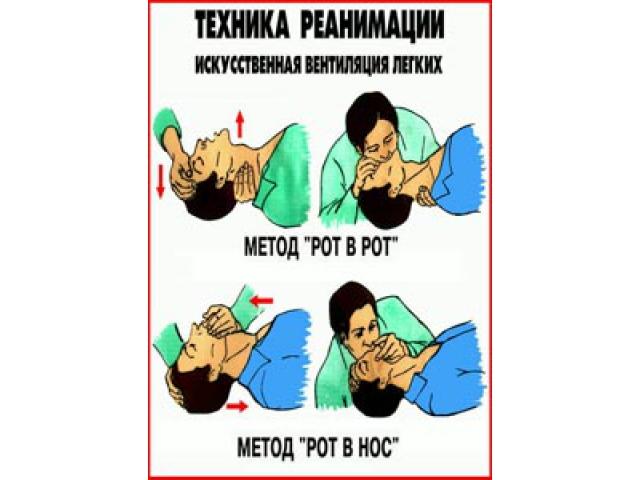 Искусственная вентиляция легких методы рот в рот рот в нос